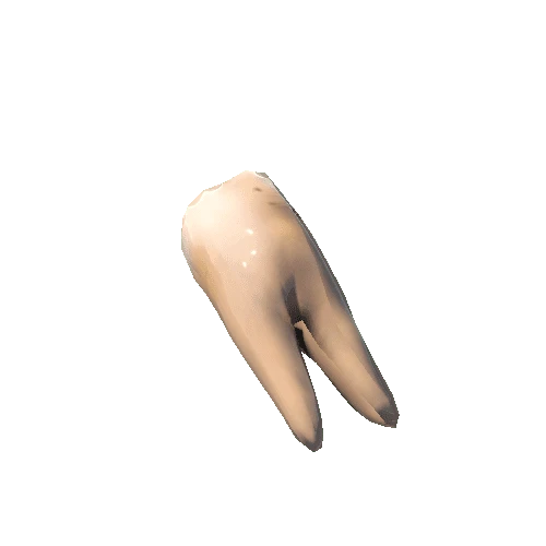 Tooth_Caries_bottom_5_L