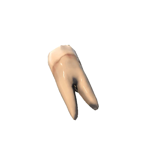 Tooth_Caries_bottom_5_R